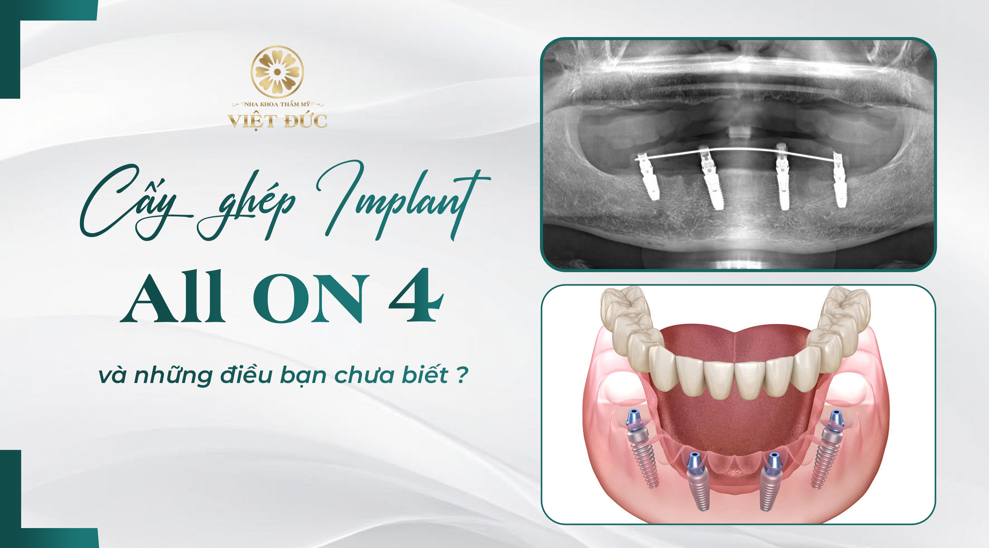 cấy ghép implant all on 4