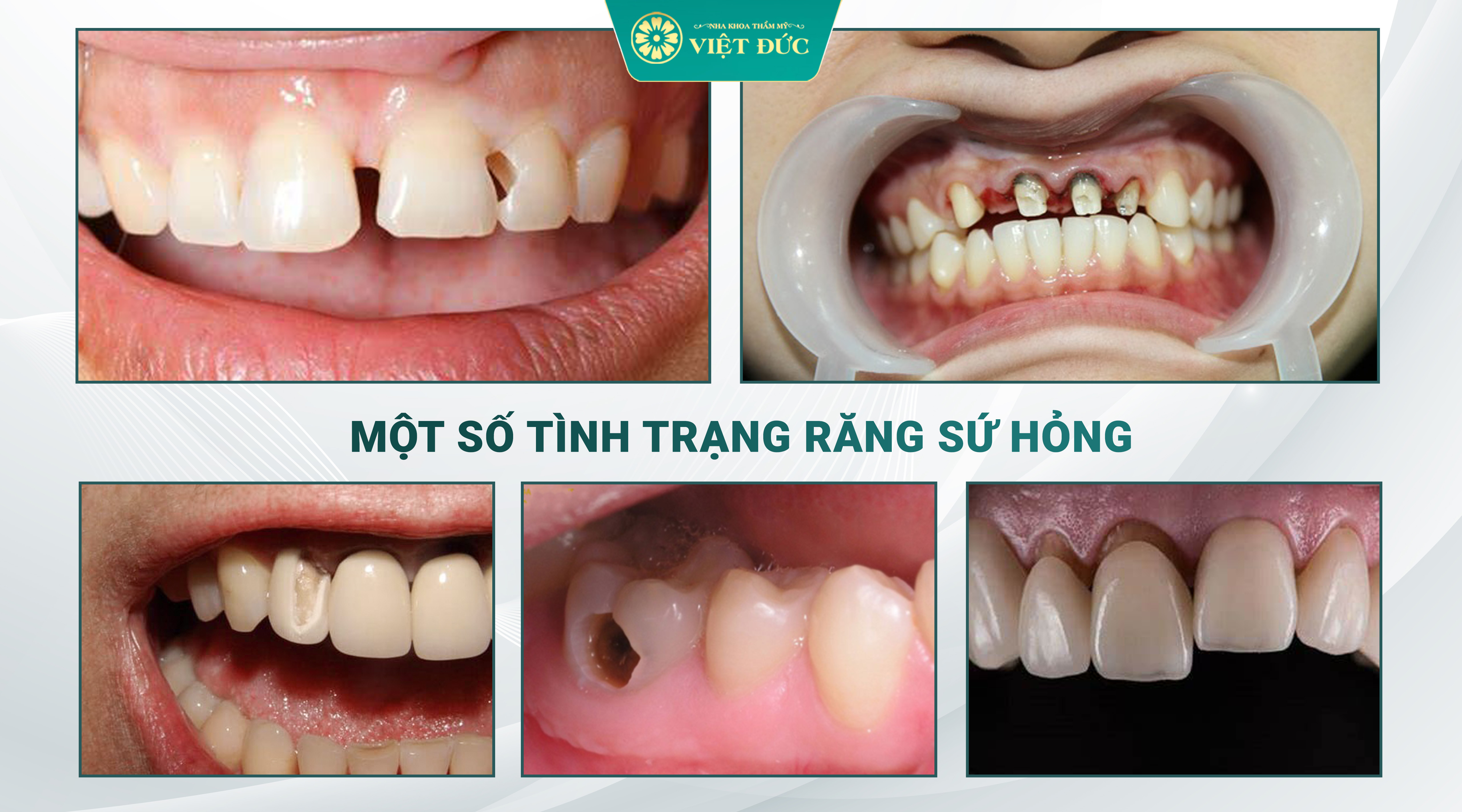 Hệ quả của răng sứ giá rẻ